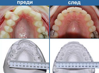 ортодонтия преди и след